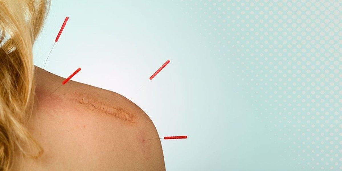 Acupuncture for Scar Tissue Treatment